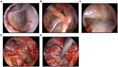 Clinical course of five patients definitively diagnosed with idiopathic perilymphatic fistula treated with transcanal endoscopic ear surgery